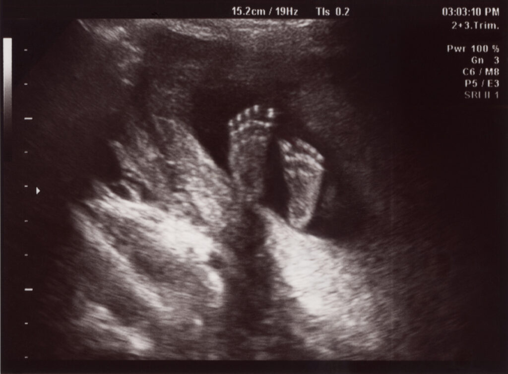 reflexology for fertility in dublin and and Infertility Support